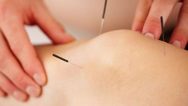 Acupuncture